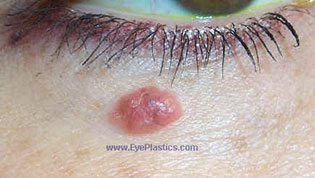 Excision of the tumor can be performed by a MOHS surgeon, an dermatologist, or an ophthalmic plastic surgeon